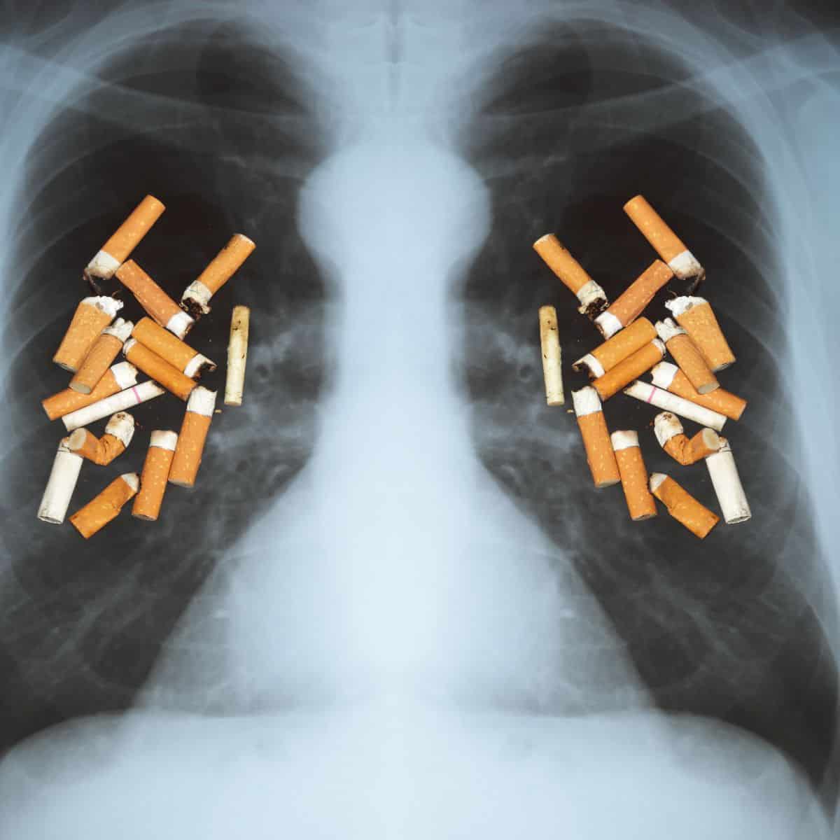 An ominous photo of an x ray of the lungs. On top of the x ray is various cigarette butts indicating health issues caused by nicotine use.